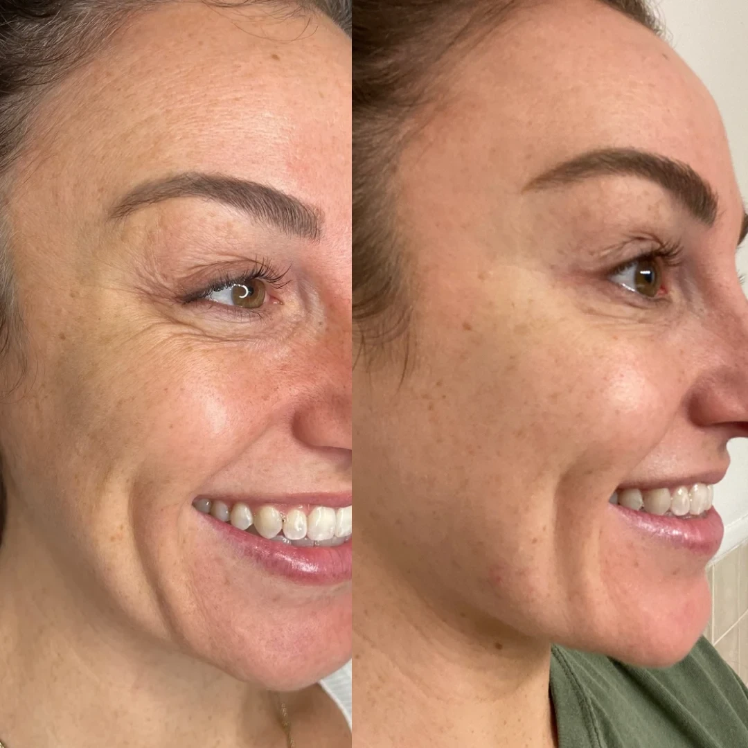 Crow's Feet Botox before and after