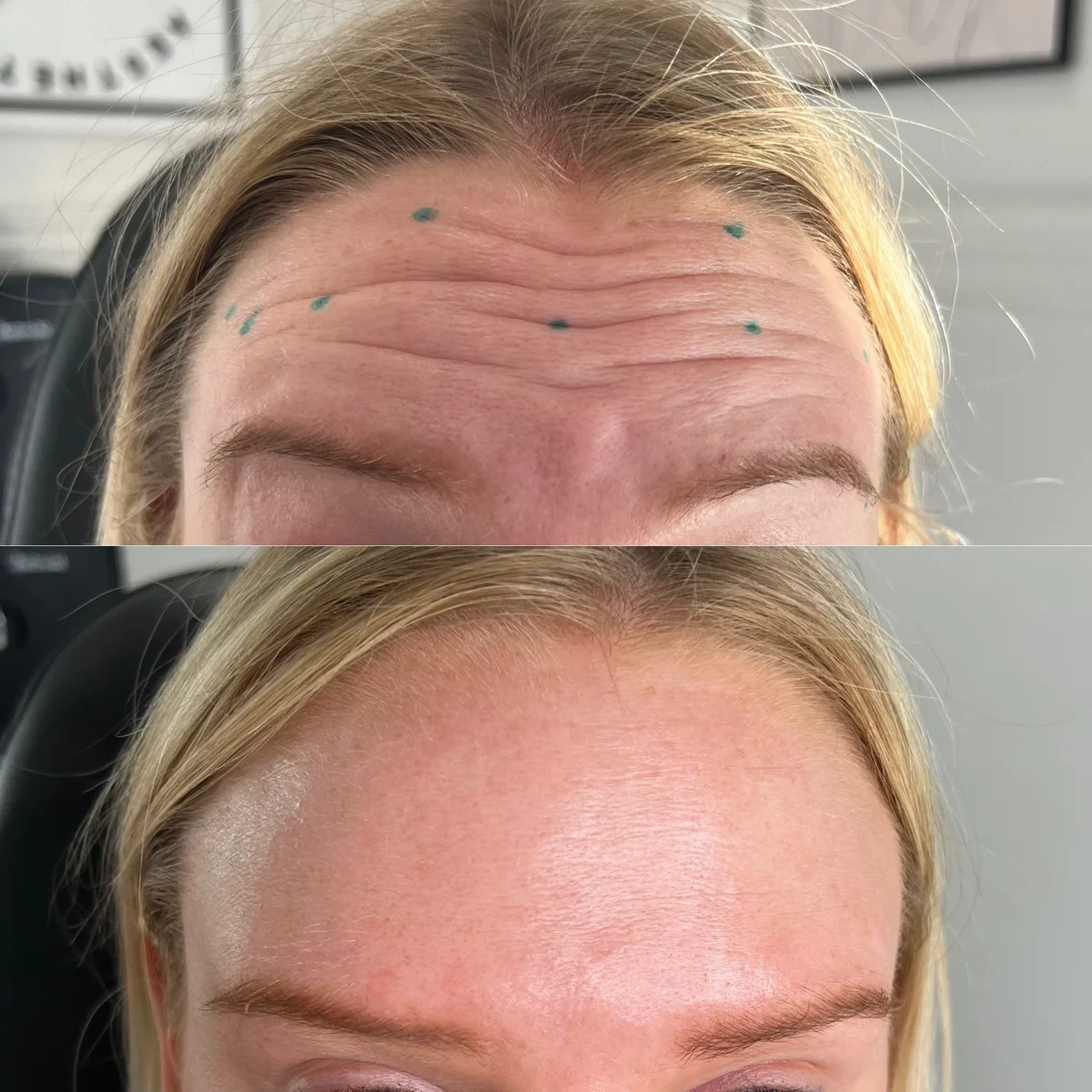 Botox before and after