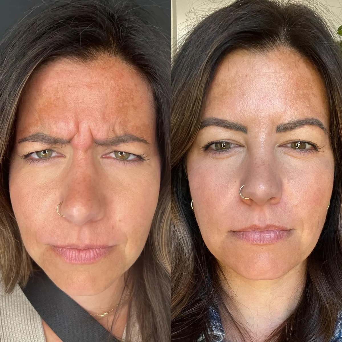 Frown Lines (11s) before and after