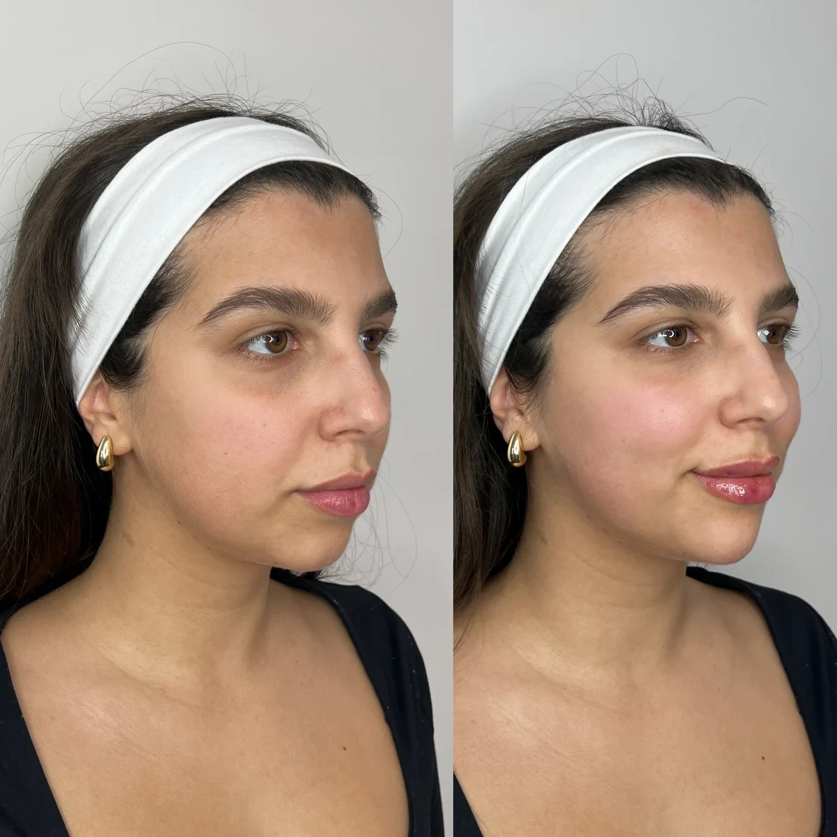 Cheek Filler before and after