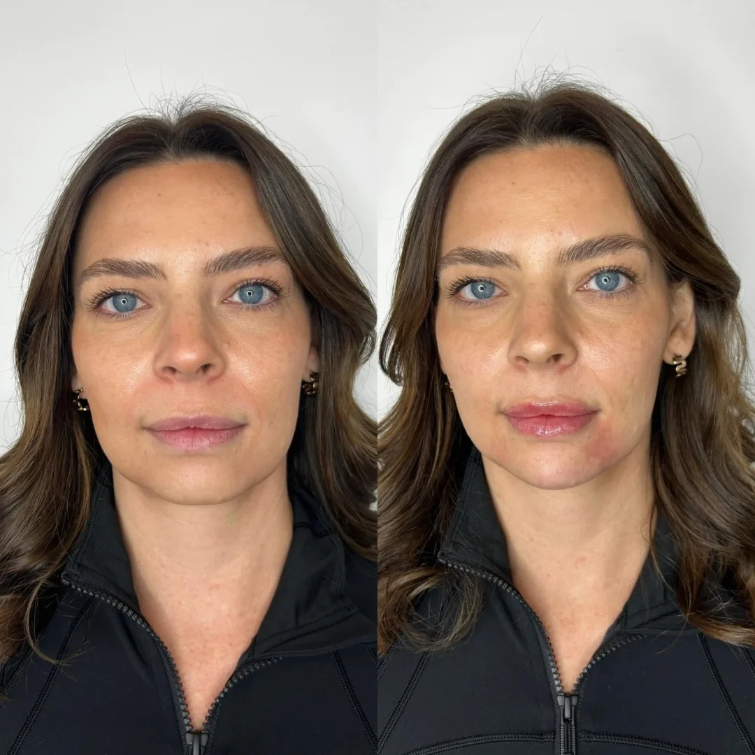 Dermal Filler before and after