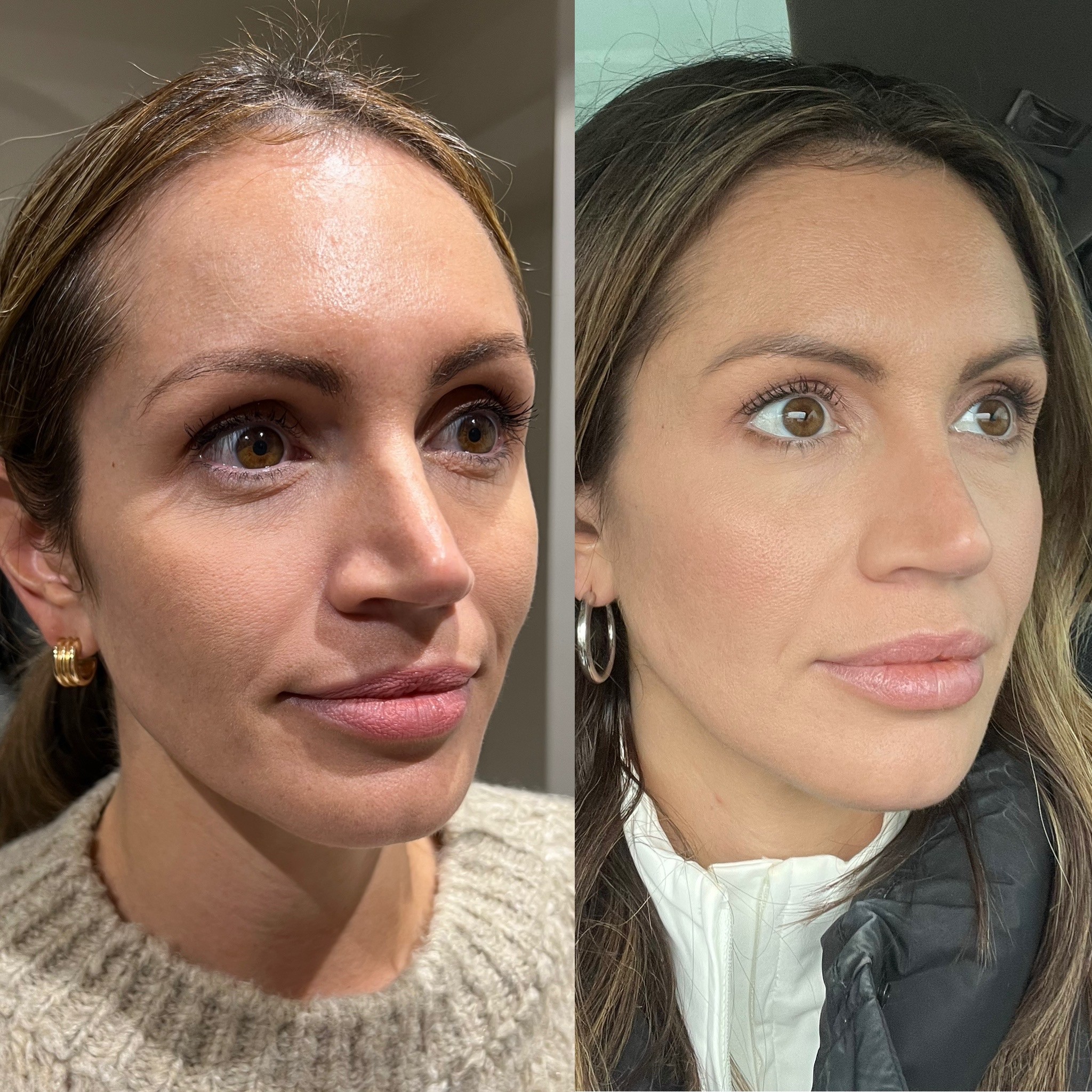 Dermal Filler before and after