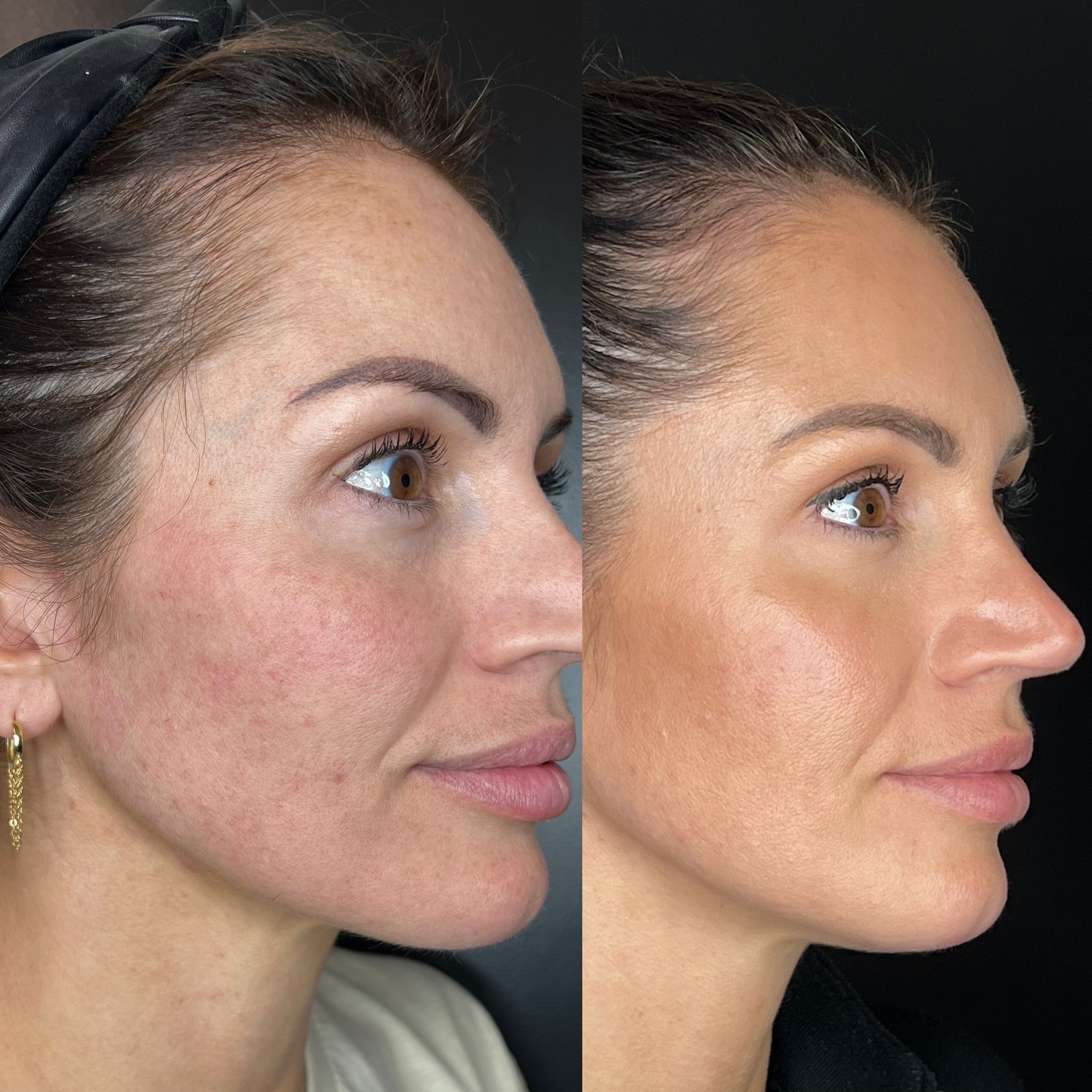 IPL for facial redness before and after