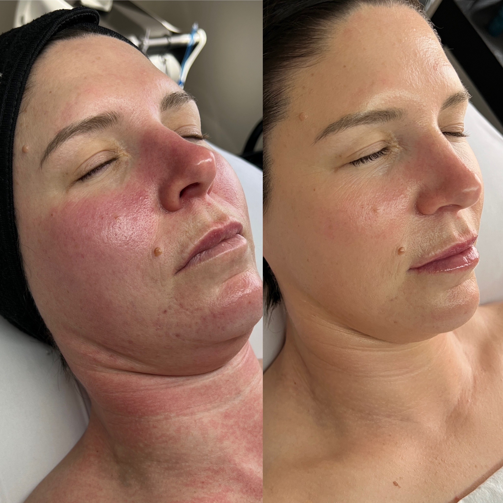 JetPeel Facial before and after
