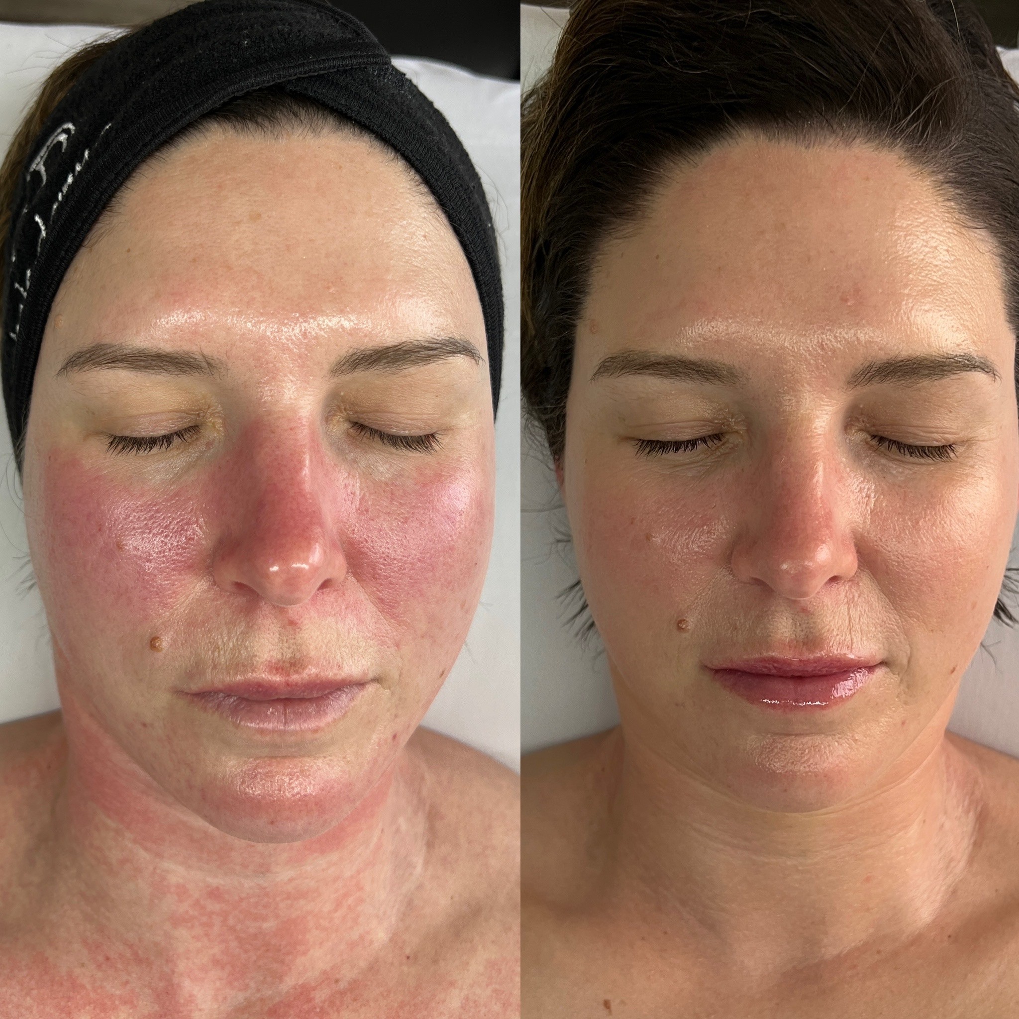 JetPeel for rosacea flush before and after