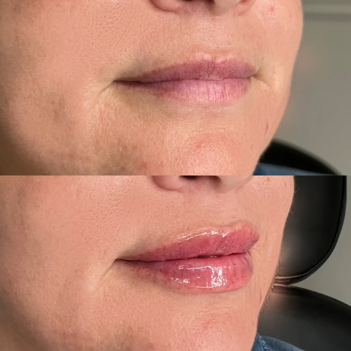 Lip Filler before and after