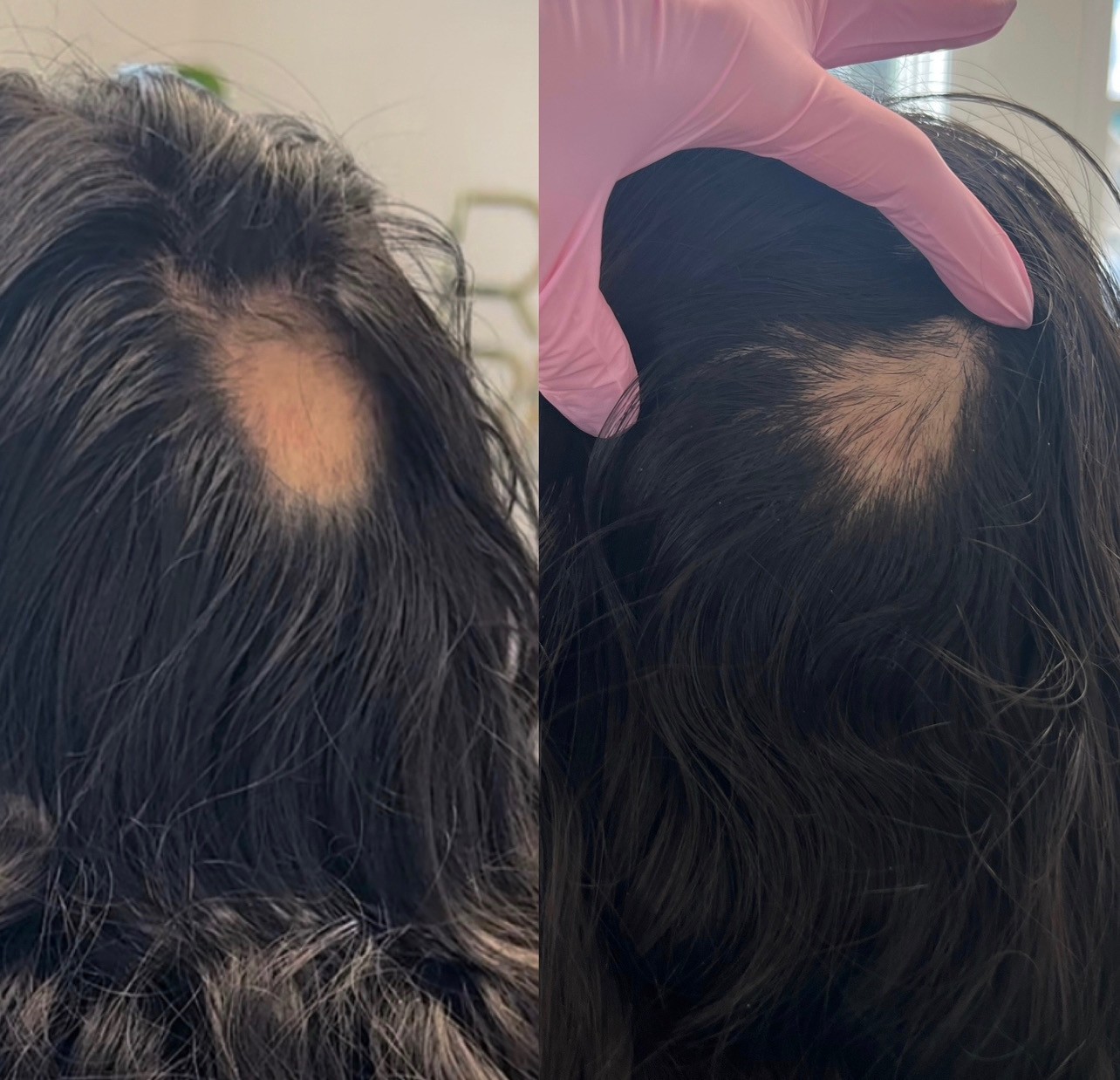 PRP Hair Restoration before and after