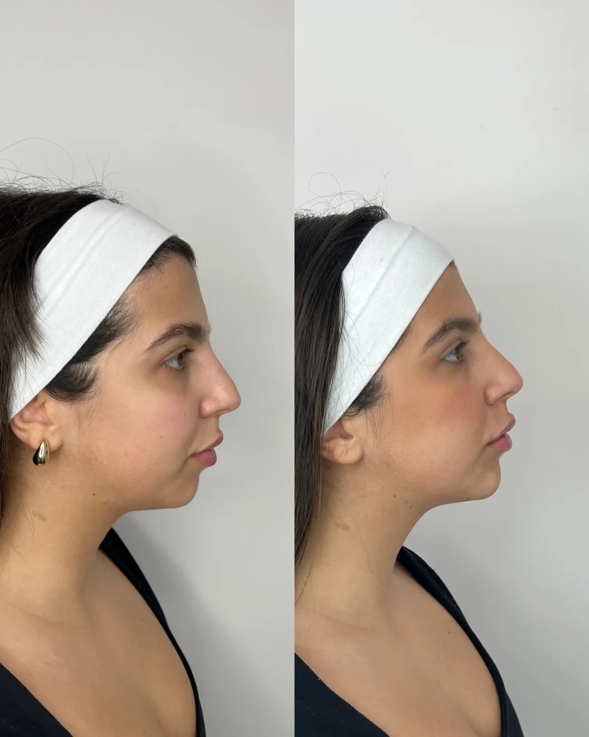 Radiesse before and after