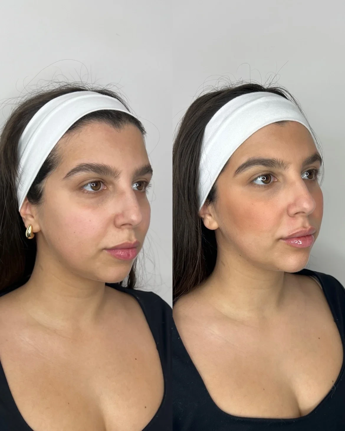 Sculptra before and after