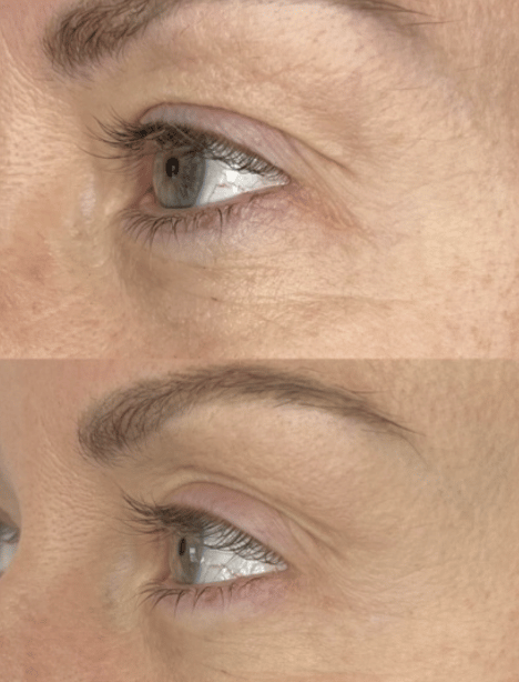 SylfirmX before and after