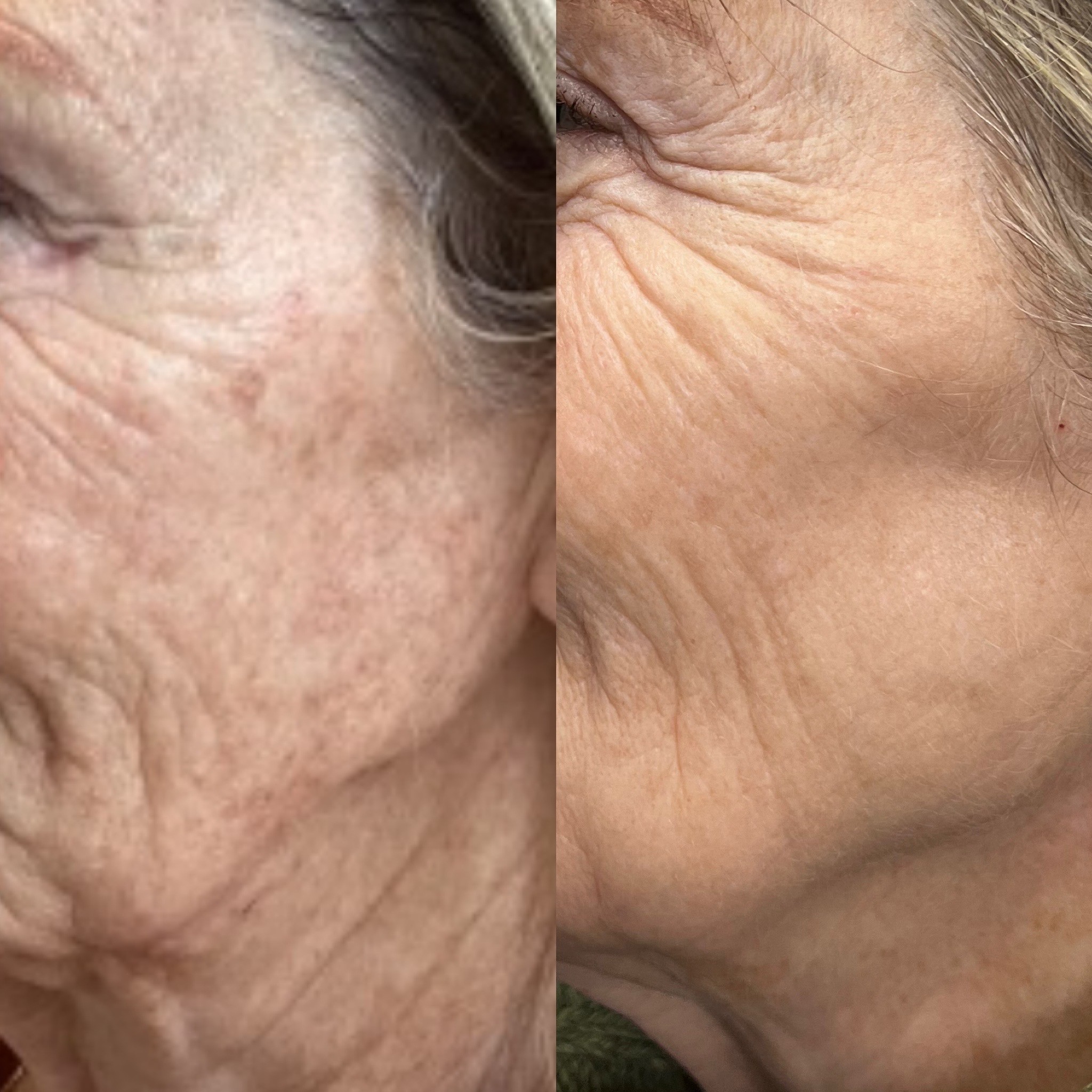 SylfirmX for under-eye pigment before and after