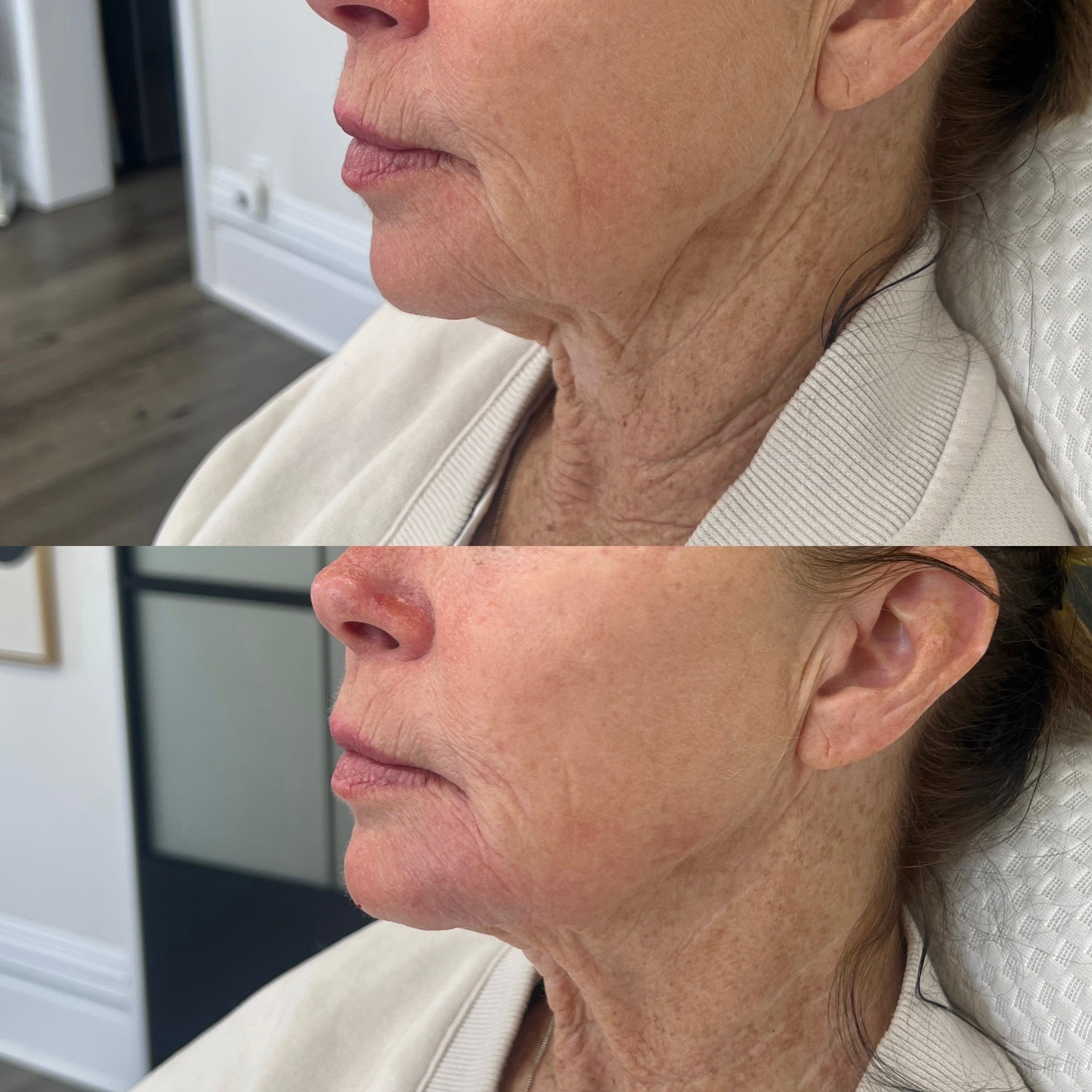 SylfirmX before and after