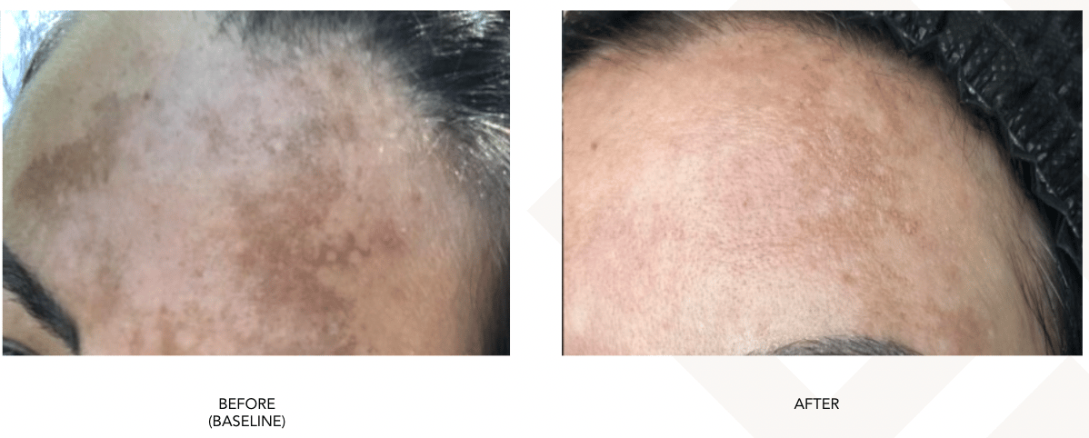SylfirmX for melasma before and after