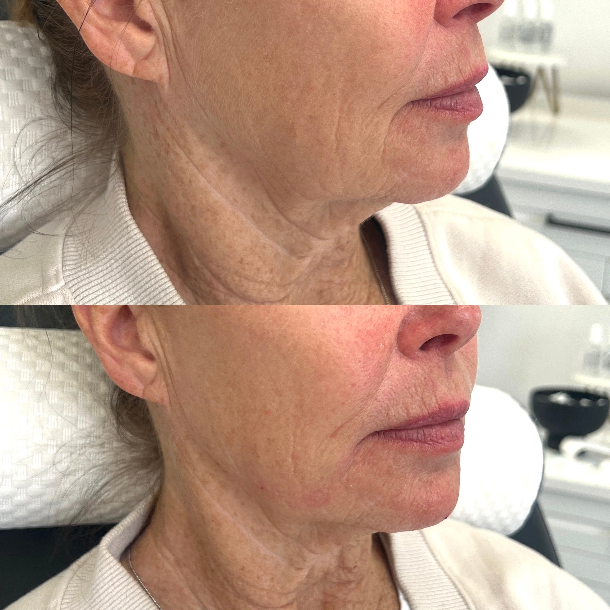 SylfirmX before and after