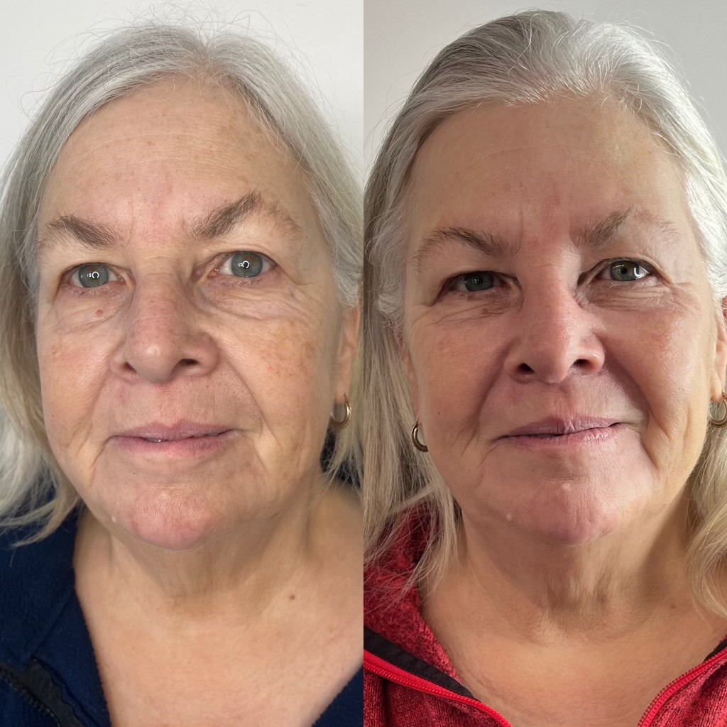 SylfirmX before and after