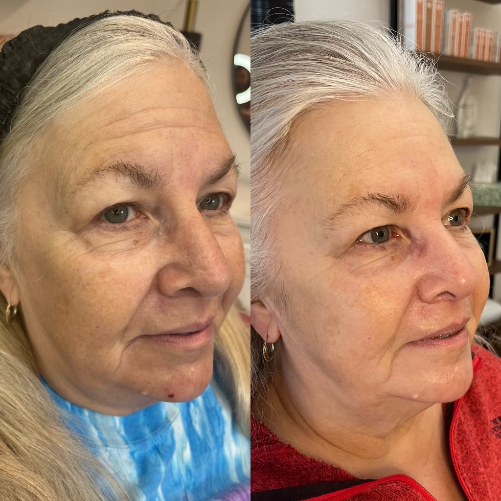 SylfirmX before and after