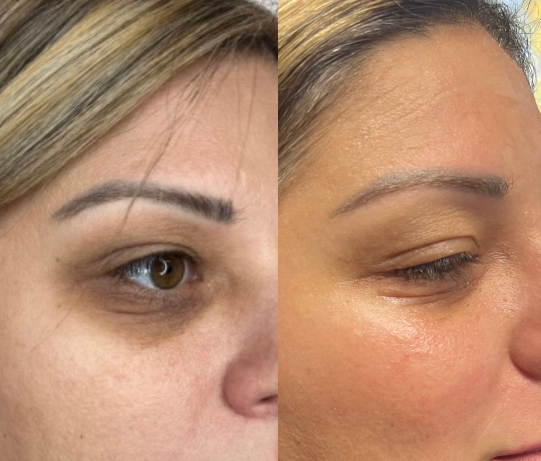 SylfirmX for the under-eye area before and after