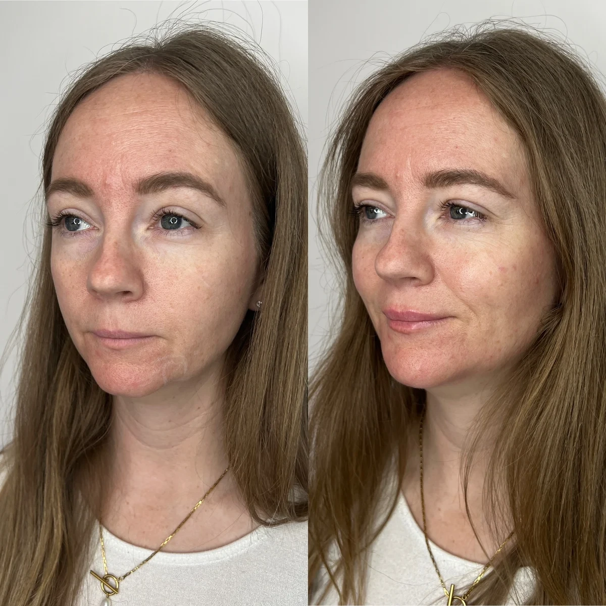 Under-Eye Filler before and after