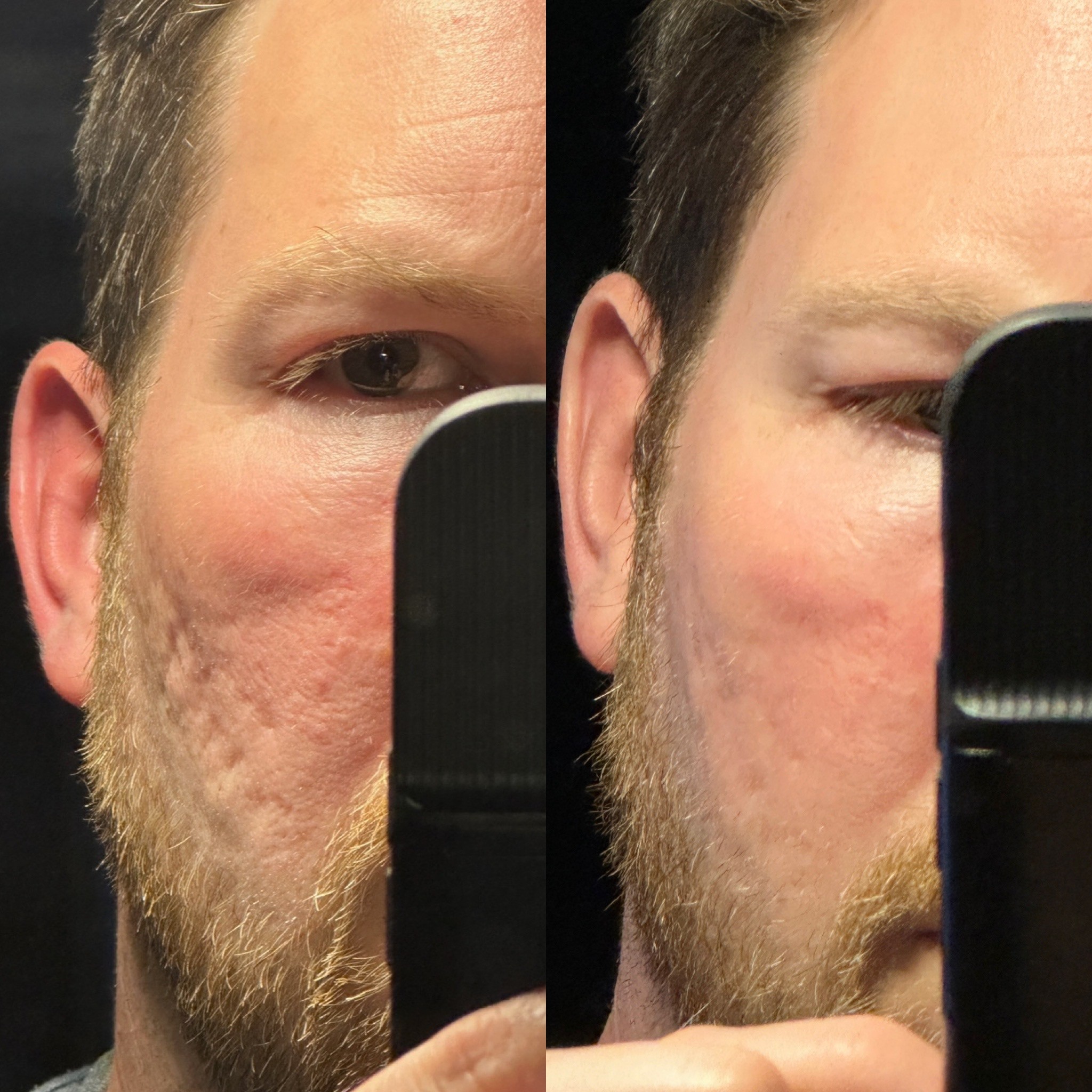 SylfirmX for acne scarring before and after
