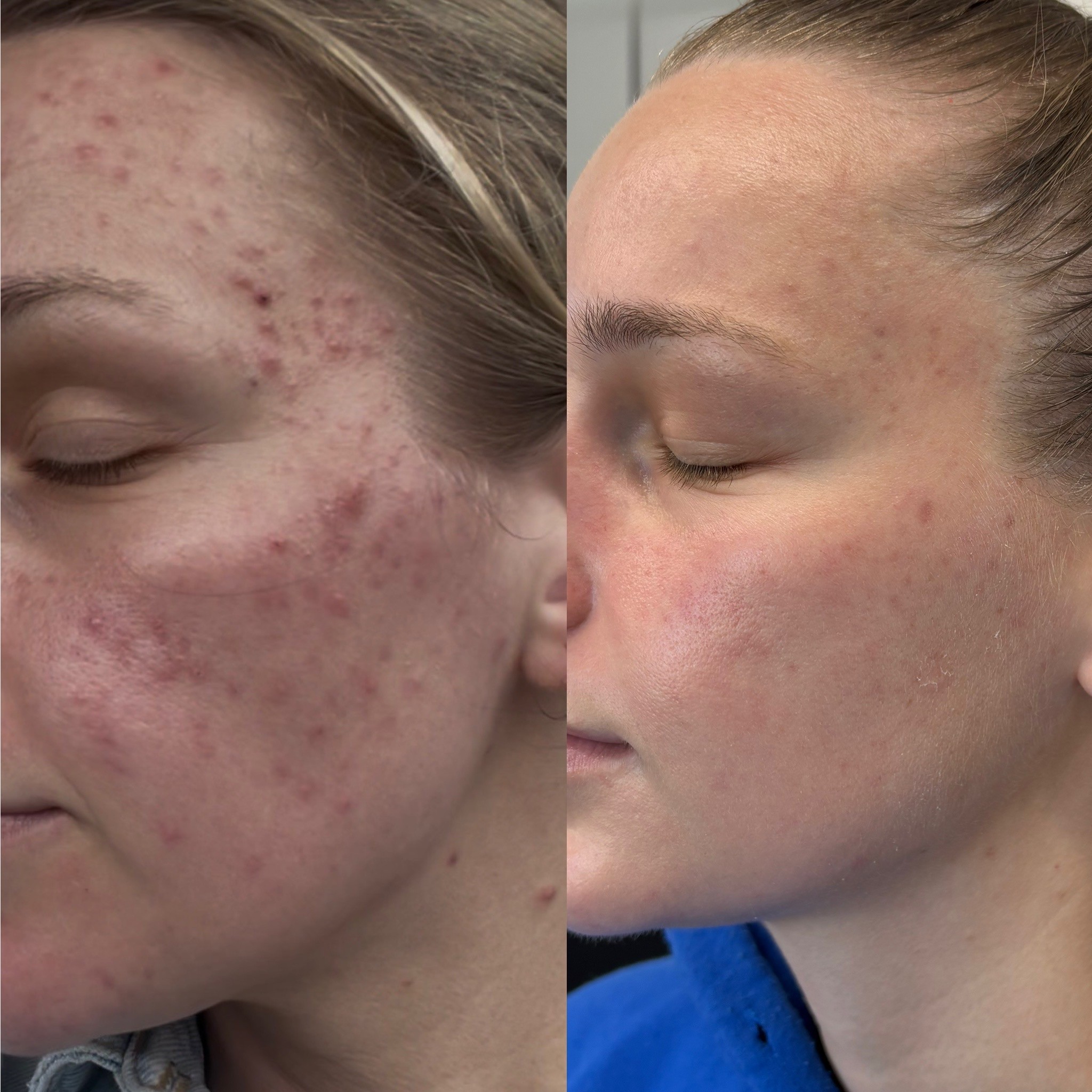 JetPeel for acne-prone skin before and after