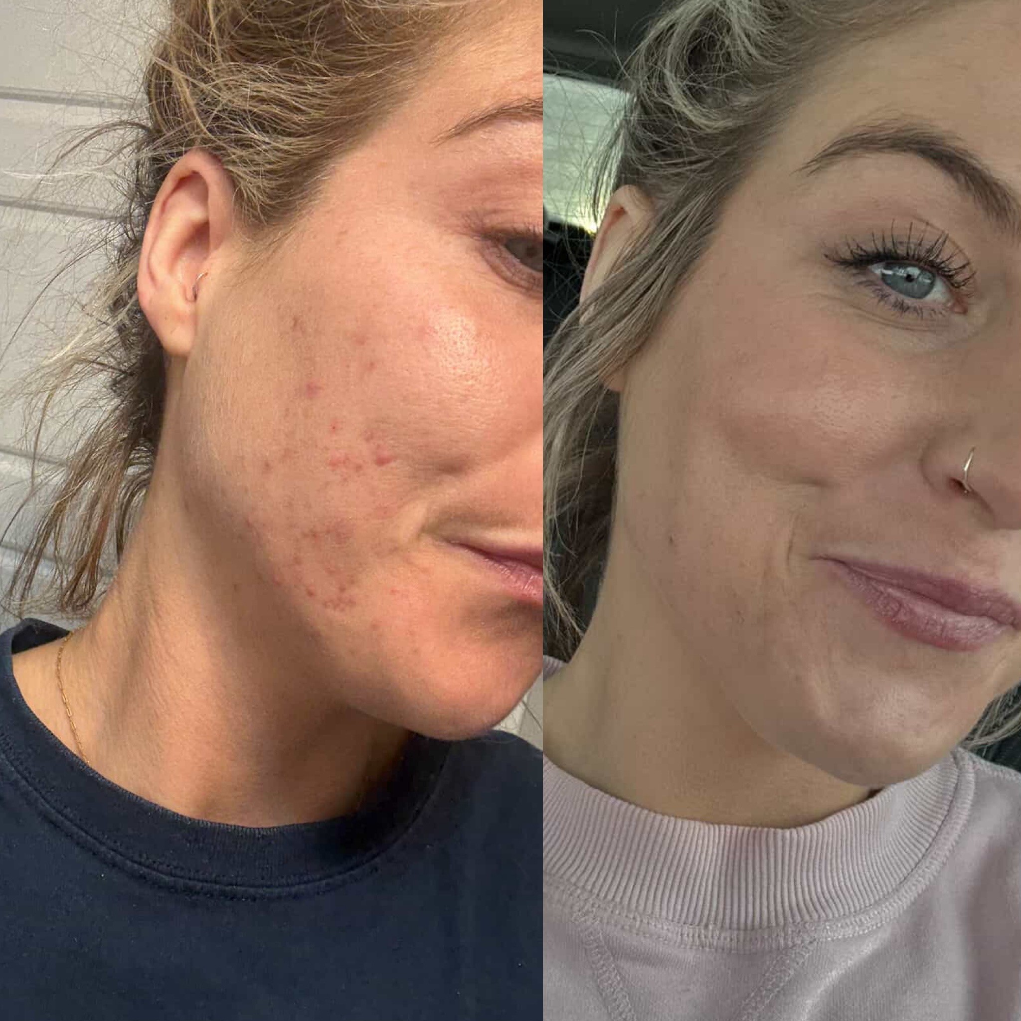 SylfirmX for acne texture before and after